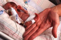 Недоношенный ребенок. Фото: web.knoxnews.com