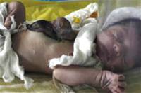 В Индии зафиксирована странная аномалия у новорожденной девочки
